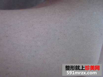 【真人案例】做了个光子脱毛,全身都光溜溜了。