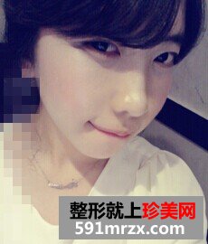 丰太阳穴+丰面颊前后效果展示