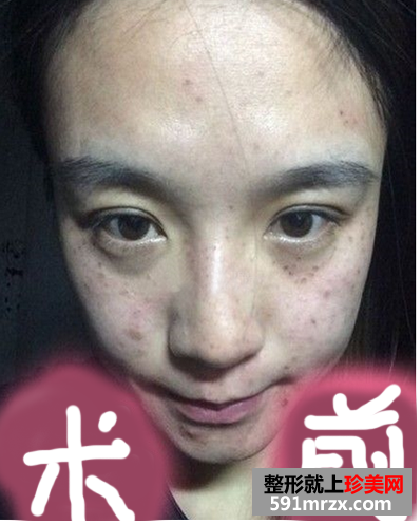 激光去斑效果如何 激光祛斑前后对比图