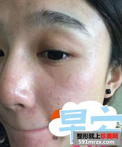 激光去斑效果如何 激光祛斑前后对比图