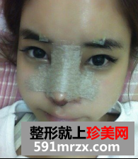 硅胶隆鼻+自体脂肪移植 那效果来说话