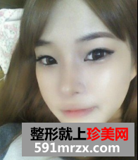 硅胶隆鼻+自体脂肪移植 那效果来说话