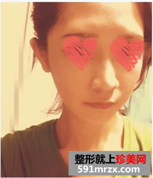 自体脂肪填充和隆鼻手术前后对比图