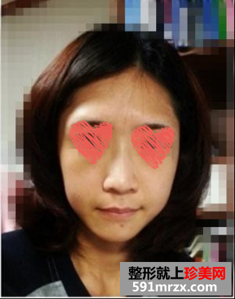 自体脂肪填充和隆鼻手术前后对比图