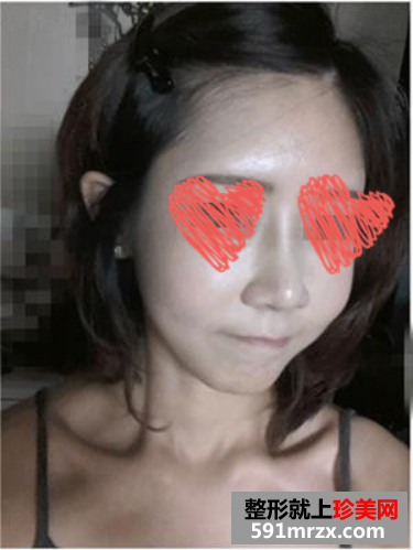 自体脂肪填充和隆鼻手术前后对比图