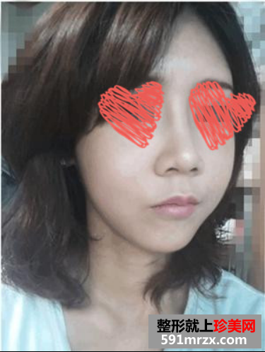 自体脂肪填充和隆鼻手术前后对比图