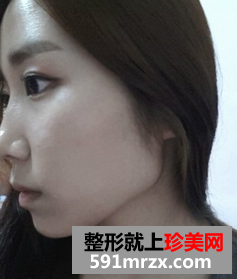 3D回转颧骨术+下颌角磨骨整形前后效果对比图和恢复过程