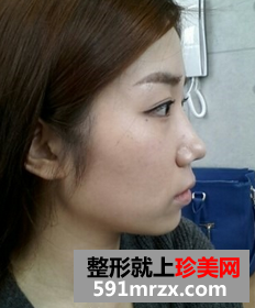 3D回转颧骨术+下颌角磨骨整形前后效果对比图和恢复过程
