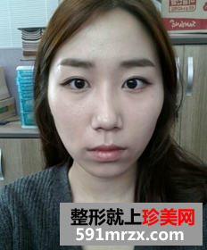 3D回转颧骨术+下颌角磨骨整形前后效果对比图和恢复过程