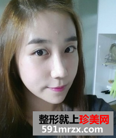 3D回转颧骨术+下颌角磨骨整形前后效果对比图和恢复过程