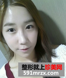 3D回转颧骨术+下颌角磨骨整形前后效果对比图和恢复过程