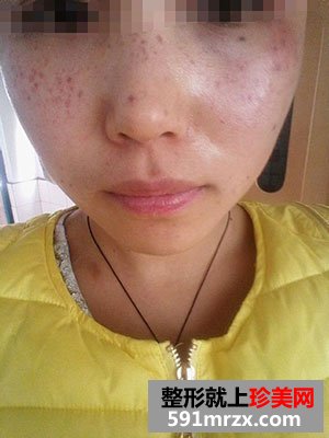 激光祛斑前后效果对比图