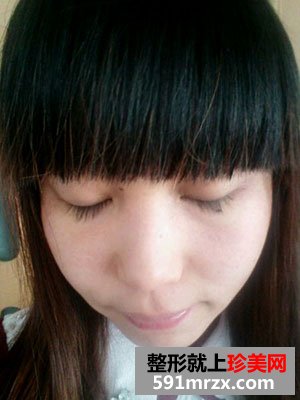 激光祛斑前后效果对比图