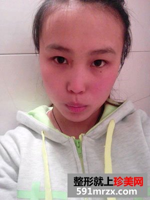 激光祛斑前后效果对比图
