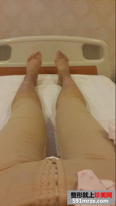 做了不久的大腿吸脂手术恢复过程