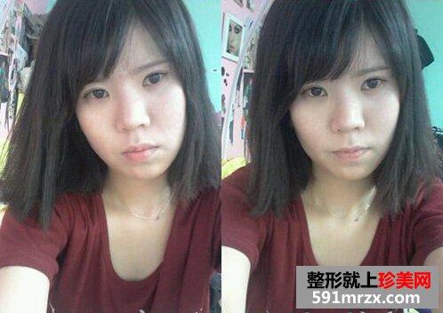 开内外眼角前后效果对比图和恢复过程
