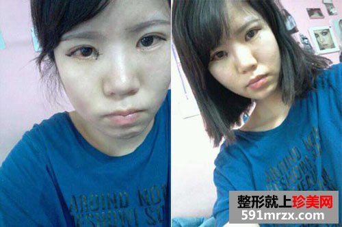 开内外眼角前后效果对比图和恢复过程