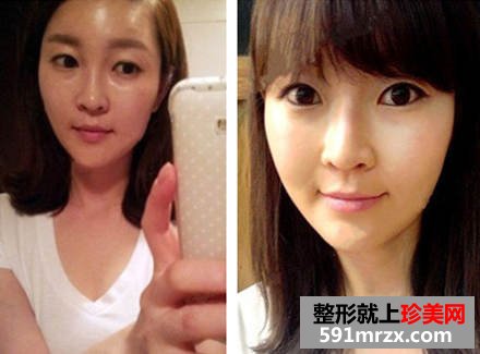 女网友面部太瘦显老 脂肪填充术后变美少女