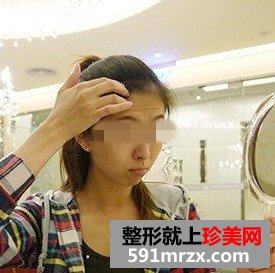面部内窥镜去除抬头纹前后对比效果图片和恢复过程