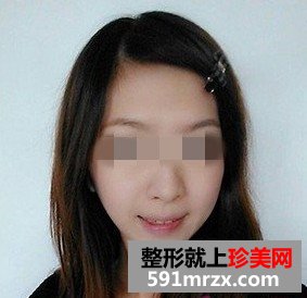 面部内窥镜去除抬头纹前后对比效果图片和恢复过程