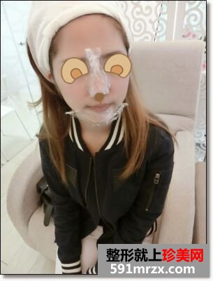 玻尿酸垫鼻子+下巴让我长相更精致了