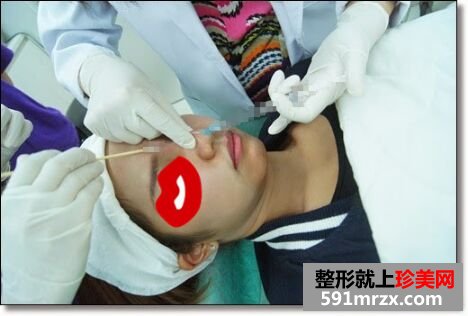 玻尿酸垫鼻子+下巴让我长相更精致了