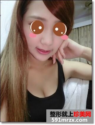 玻尿酸垫鼻子+下巴让我长相更精致了