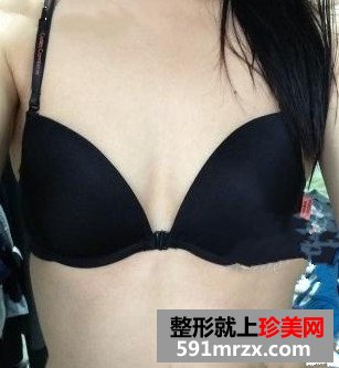 自体脂肪隆胸前后效果对比图和恢复过程