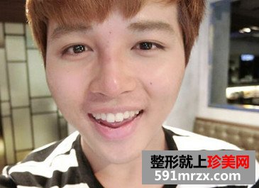 男生玻尿酸隆鼻后立马变身时尚欧巴