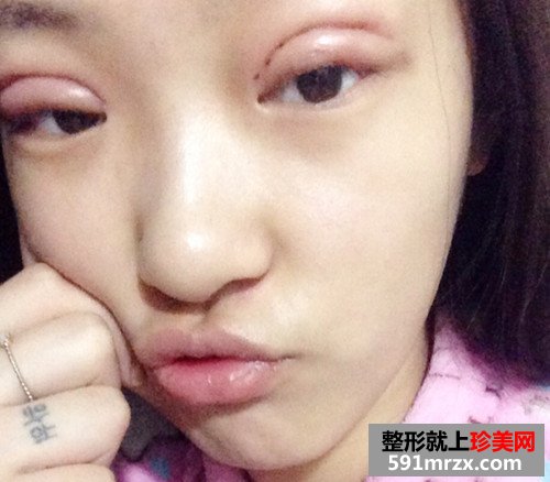 生物焊接双眼皮几天后拆线?看看我的手术前后对比效果图片恢复过程