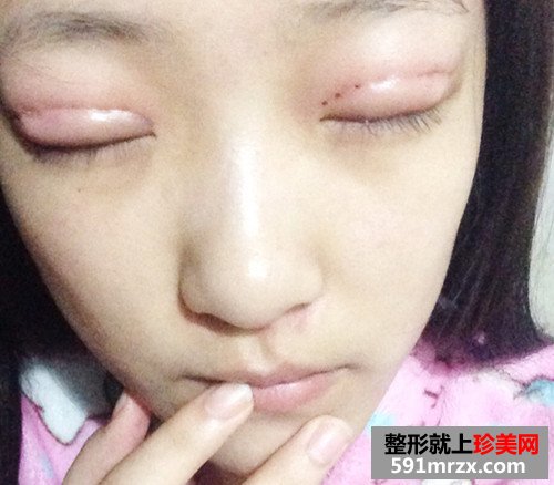 生物焊接双眼皮几天后拆线?看看我的手术前后对比效果图片恢复过程