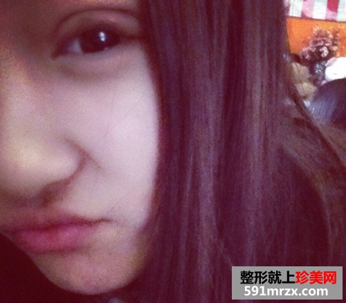 生物焊接双眼皮几天后拆线?看看我的手术前后对比效果图片恢复过程