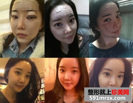 自体脂肪填充面部让我变身美少女