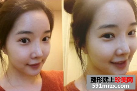 自体脂肪填充面部让我变身美少女