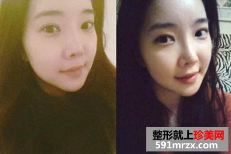 自体脂肪填充面部让我变身美少女