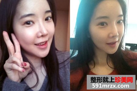 自体脂肪填充面部让我变身美少女