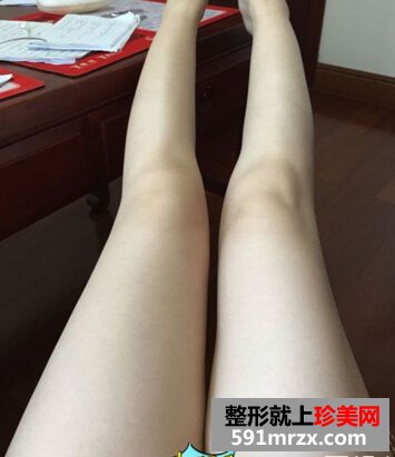 为了更瘦一些做了面部吸脂+大腿吸脂