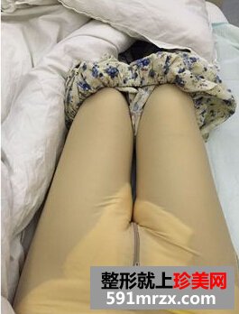 为了更瘦一些做了面部吸脂+大腿吸脂