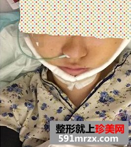 为了更瘦一些做了面部吸脂+大腿吸脂