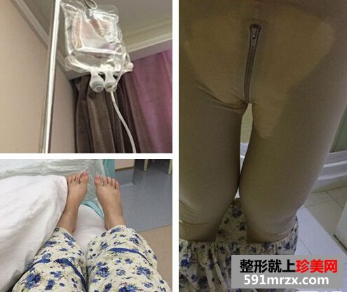 为了更瘦一些做了面部吸脂+大腿吸脂