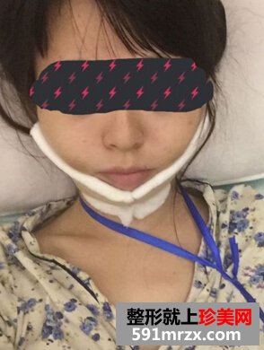 为了更瘦一些做了面部吸脂+大腿吸脂