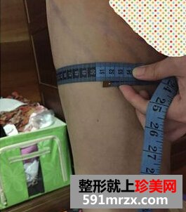 为了更瘦一些做了面部吸脂+大腿吸脂
