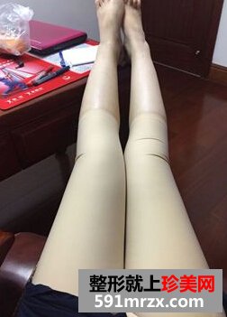 为了更瘦一些做了面部吸脂+大腿吸脂