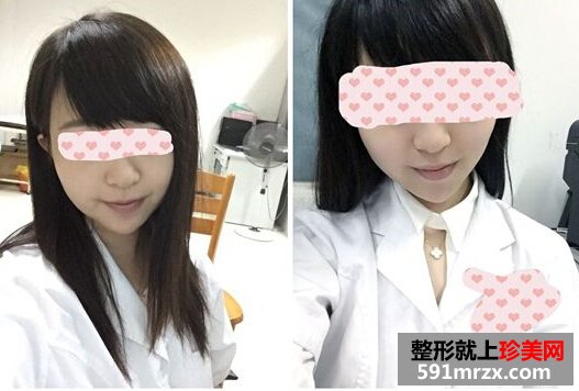 为了更瘦一些做了面部吸脂+大腿吸脂