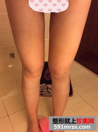 为了更瘦一些做了面部吸脂+大腿吸脂