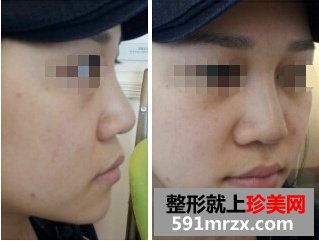 隆鼻失败后修复 效果确实不错