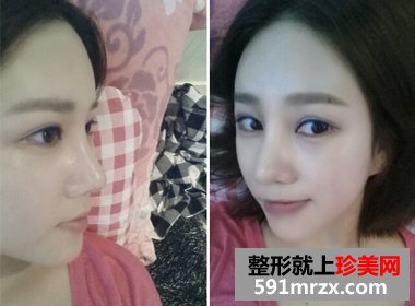 隆鼻失败后修复 效果确实不错