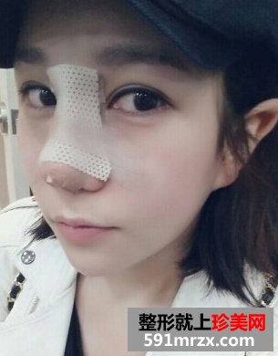 隆鼻失败后修复 效果确实不错