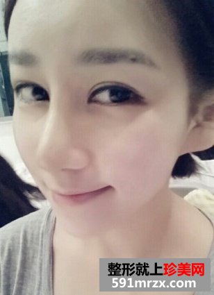 隆鼻失败后修复 效果确实不错