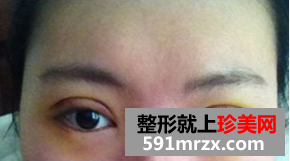 上海华美韩式三点双眼皮恢复图